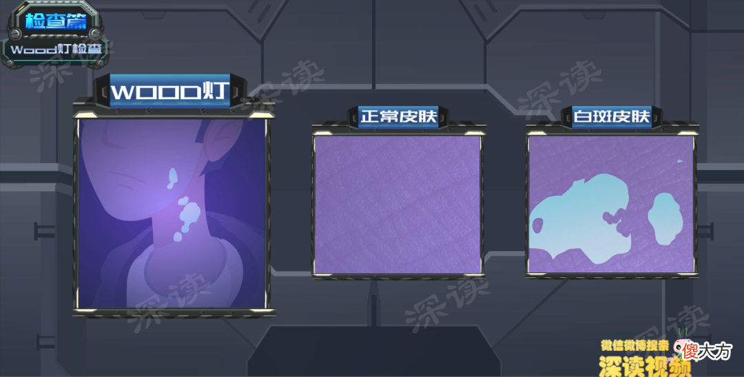 激光治疗和皮肤移植哪家强？治疗白癜风，最新黑科技大盘点