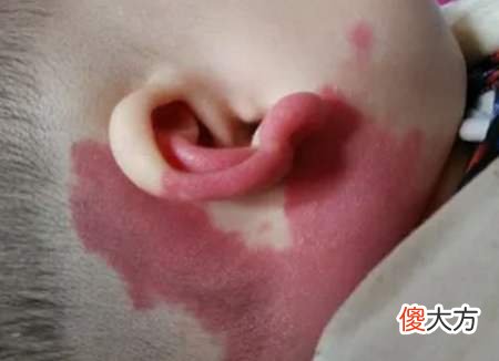 宝宝出现“鹤吻痕”怎么办？家长不要乱处理，做错了有可能会加深颜色