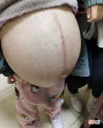 图片是昨天上午接诊的一个9岁小女孩，非常罕见的疾病——门静脉海绵样病变