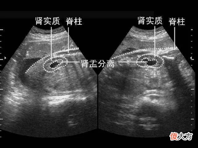 胎儿肾盂分离是什么？?