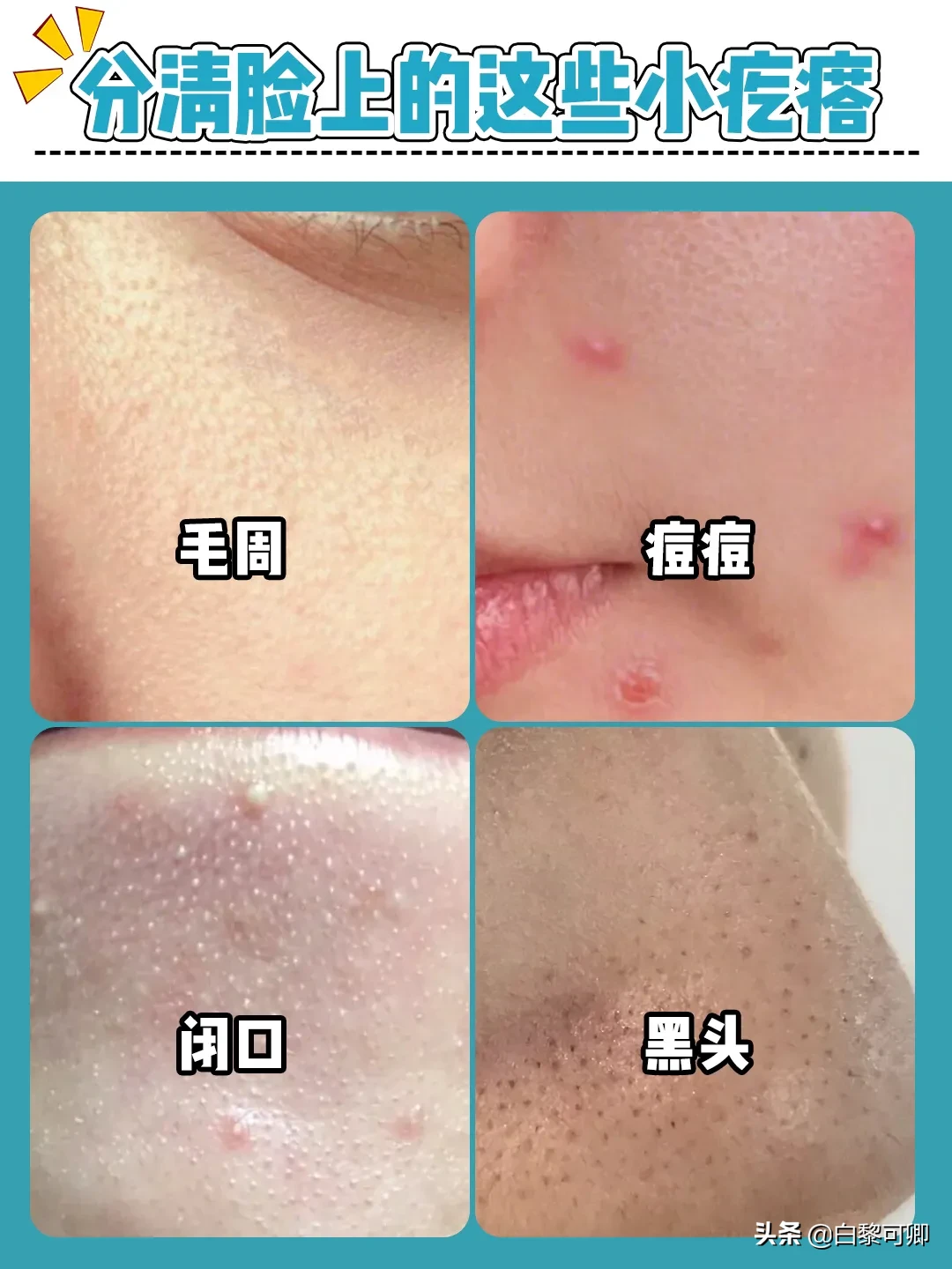 护肤小知识|开始爱美那会就研究护肤了，那时候皮肤还挺好，偶尔几颗小痘痘