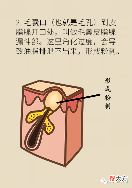 【时尚一点】痘痘反复就是好不了？可能因为做错了这件事