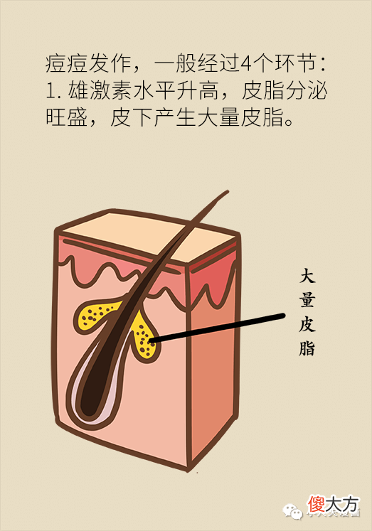 【时尚一点】痘痘反复就是好不了？可能因为做错了这件事