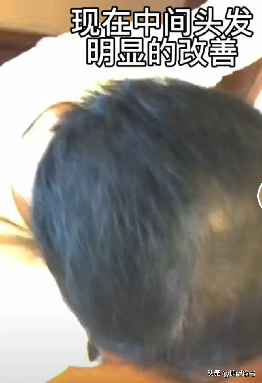 浙江一男子分享洗头发心得的视 频火了，怎么回事呢？原来男子因为雄性 激素秃发有点
