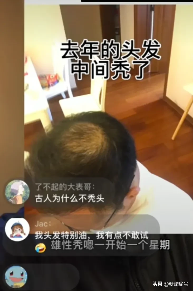 浙江一男子分享洗头发心得的视 频火了，怎么回事呢？原来男子因为雄性 激素秃发有点