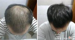 【就爱时尚】如何预防头发稀少的现象？3个日常方法，长期坚持，或能帮到你