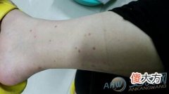 梦见虫子咬我(图文)