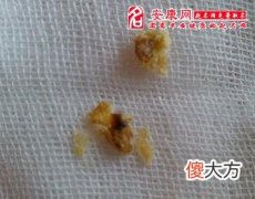 梦见耳屎(图文)