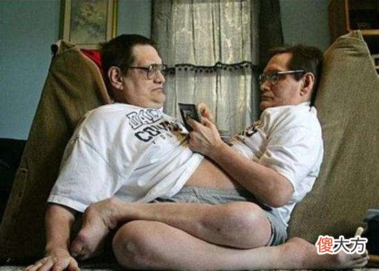 世界上奇葩的连体婴儿，连体人共用一个头部