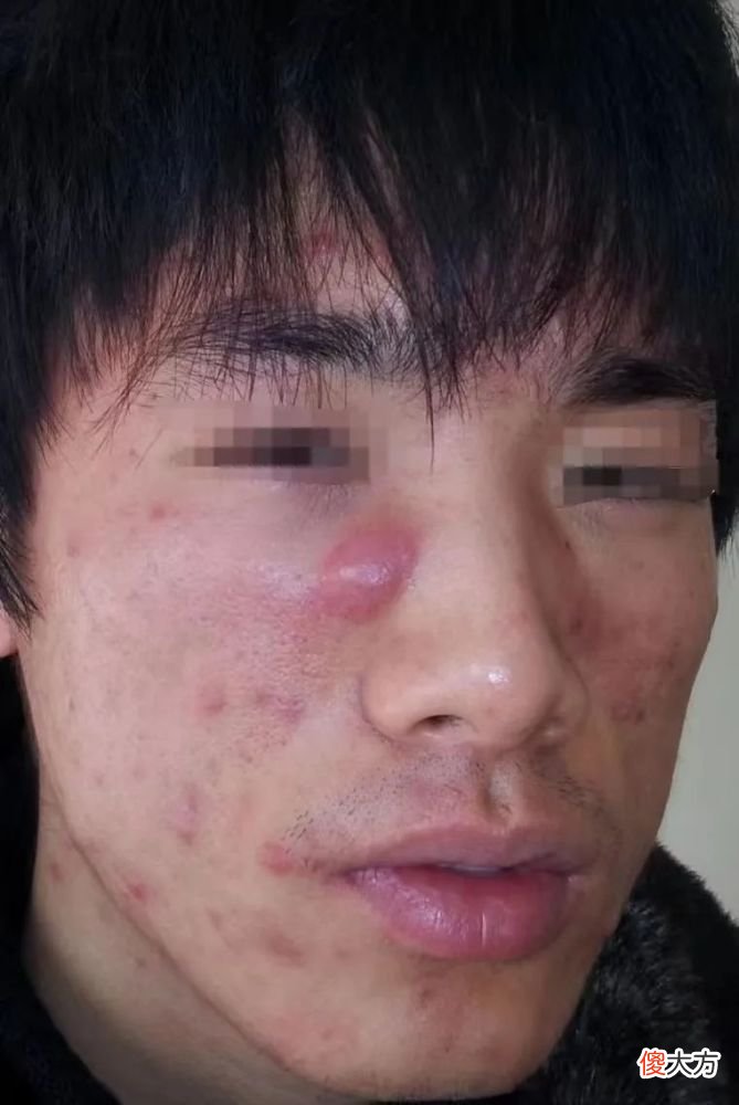 【就爱时尚】认识一下 青少年寻常痤疮