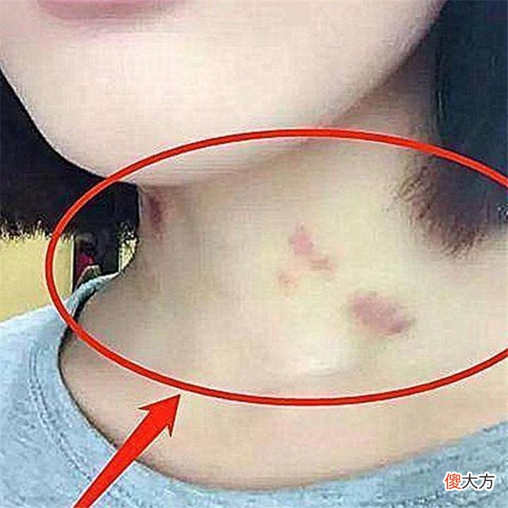 15岁女儿脖子上有“草莓印”,父母逼问原因,女儿回答让他们羞愧