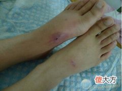 解读梦见被蛇咬脚从不同角度来看(图文)